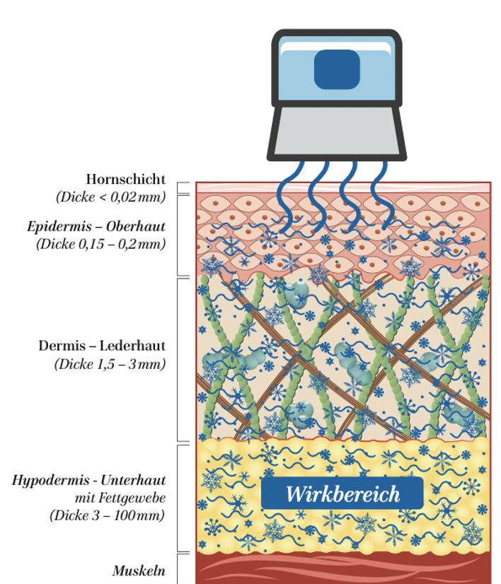 Wirkbereich KRYOfee WELLNESSfee Leipzig Kryolipolyse
